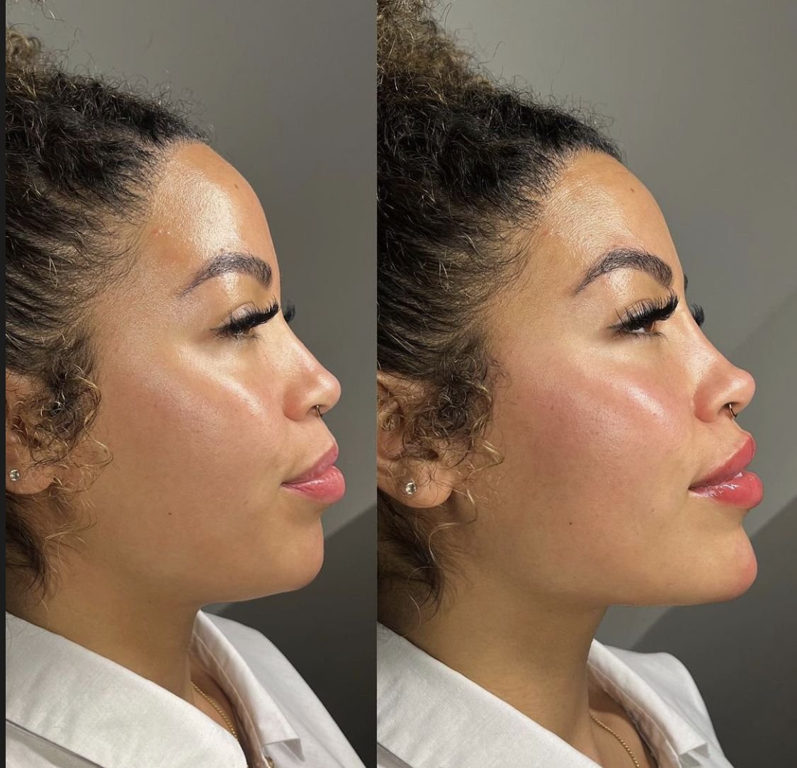 1 ml Cheek Filler Before and After