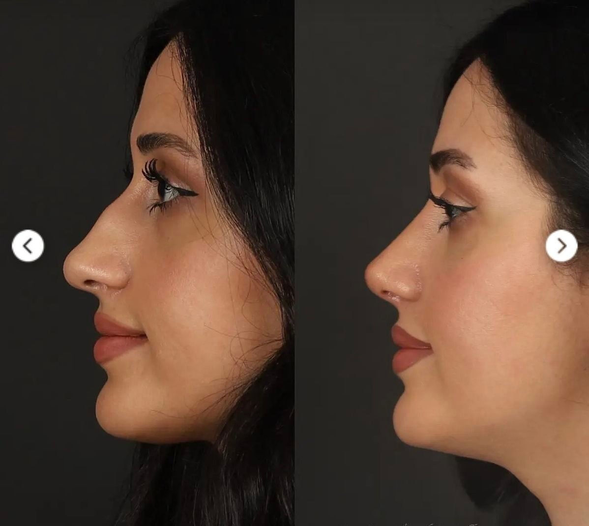 Non Surgical Nose Job Near Me