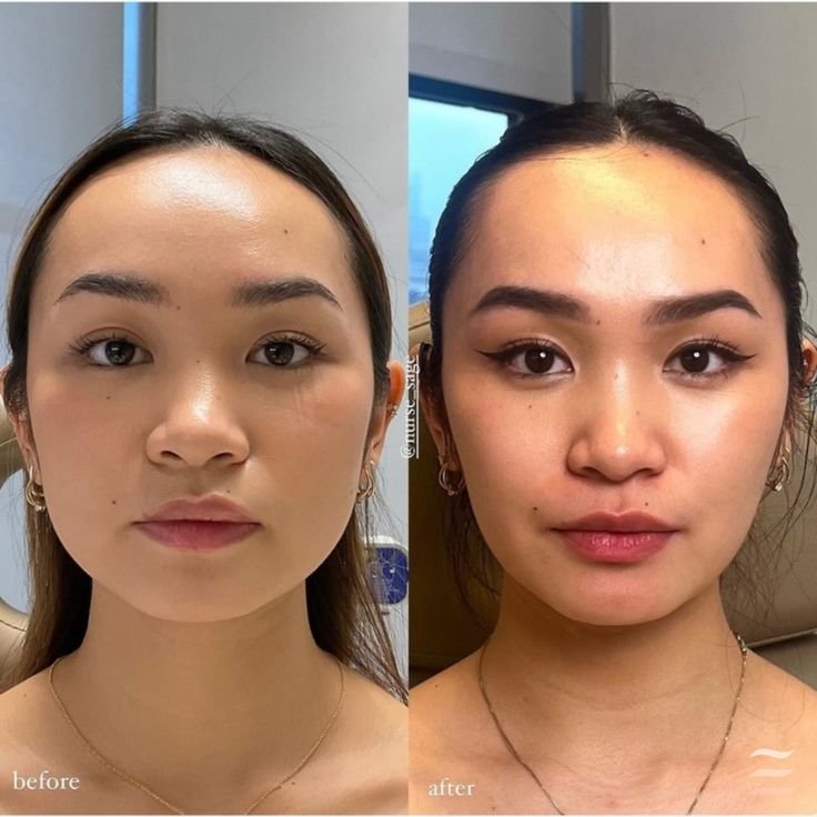 Buy Masseter Botox Online