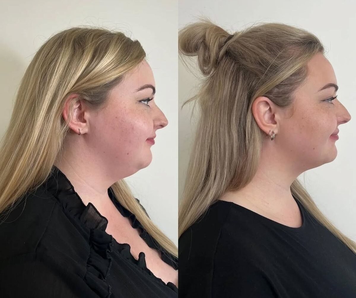 Buy Chin Filler Online