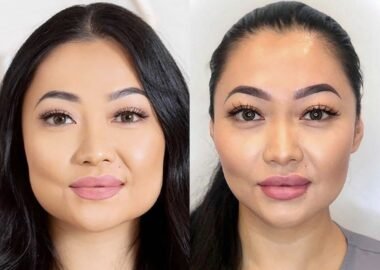 masseter botox vorher nachher