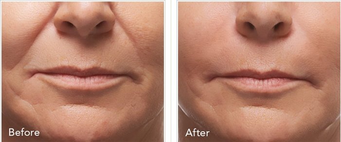  Radiesse Before and After Results: Timeline and Where to Buy Radiesse Online Safely