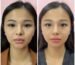 Buy Masseter Botox Online for Jaw Slimming and Bruxism Treatment