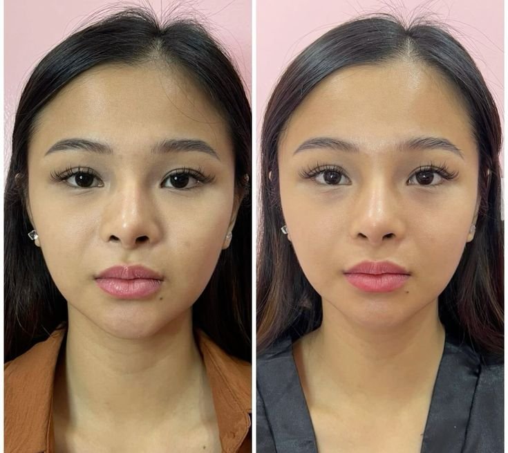 Buy Masseter Botox Online for Jaw Slimming and Bruxism Treatment