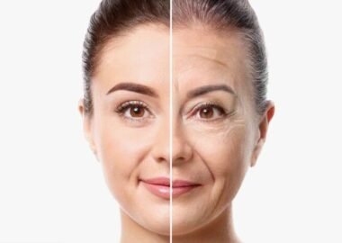 marionette lines treatment