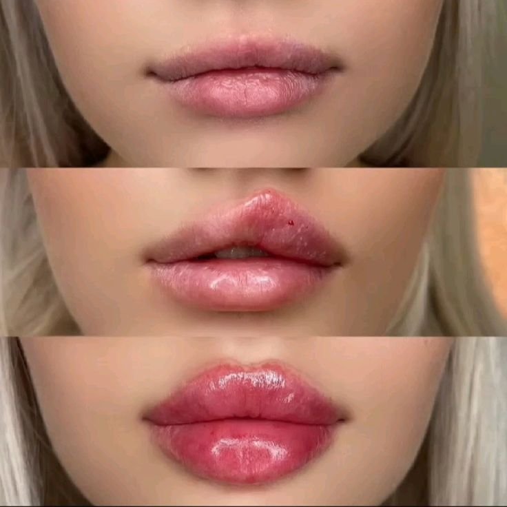 Lip Filler Swelling Stages