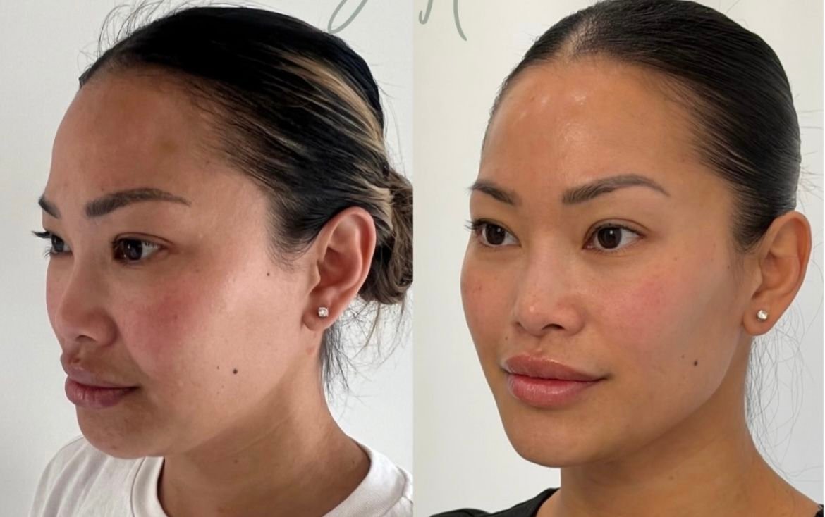 Buy Masseter Botox Online for Jaw Slimming 