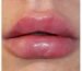 1 ML Lip Filler Swelling Stages