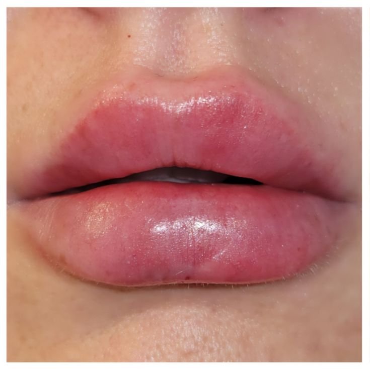 1 ML Lip Filler Swelling Stages