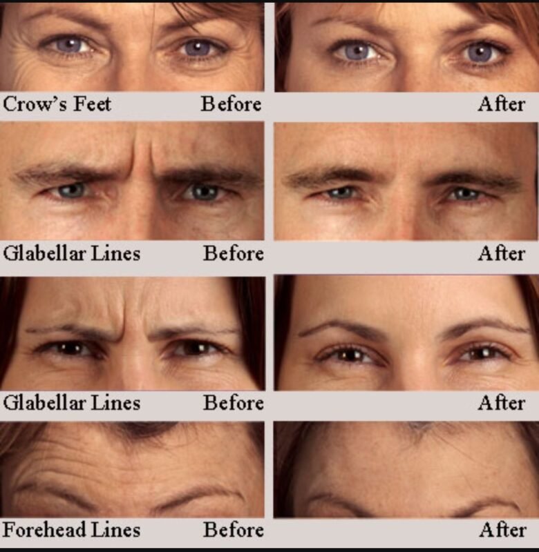 The Power of Dermal Filler Transformation for Facial Harmony