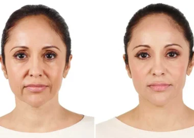 radiesse before and after