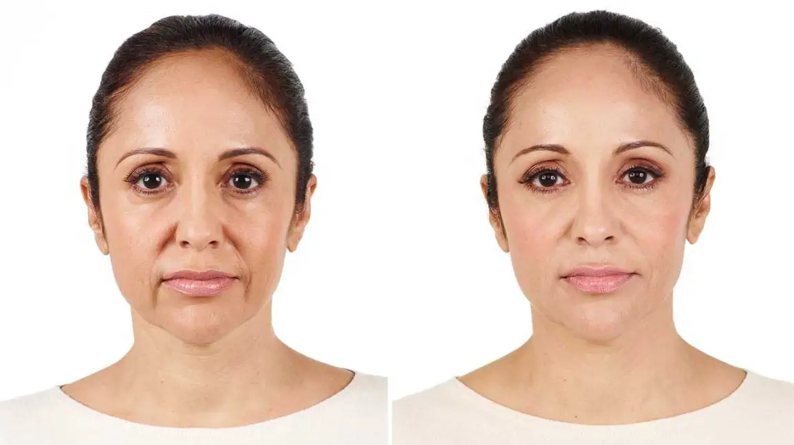 radiesse before and after