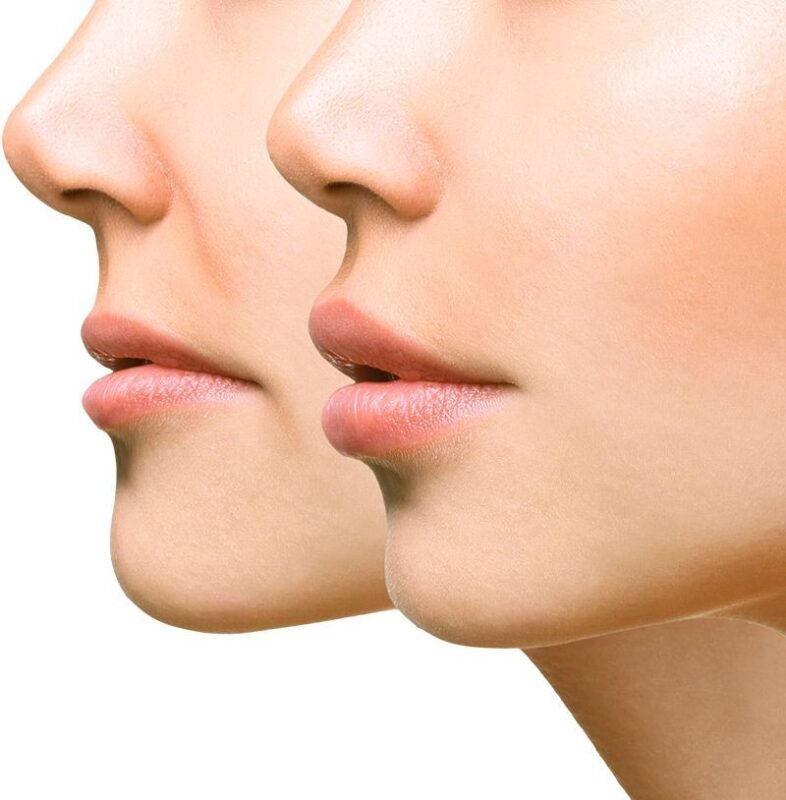  Buy Nasolabial Fold Filler Online