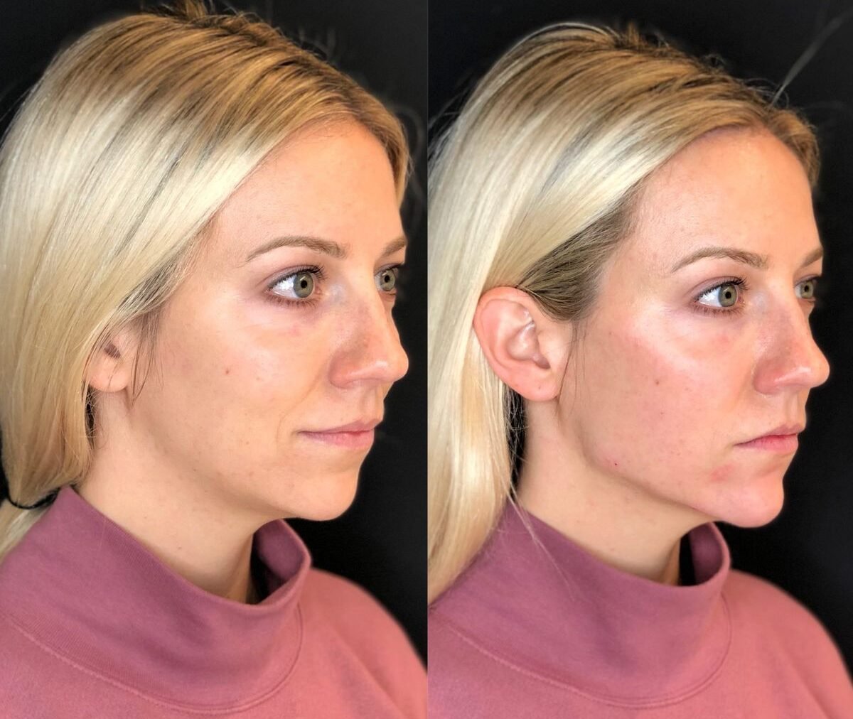 Buy Jawline Filler Online