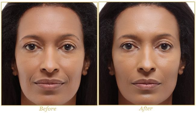 Radiesse Behandlung Kaufen Online