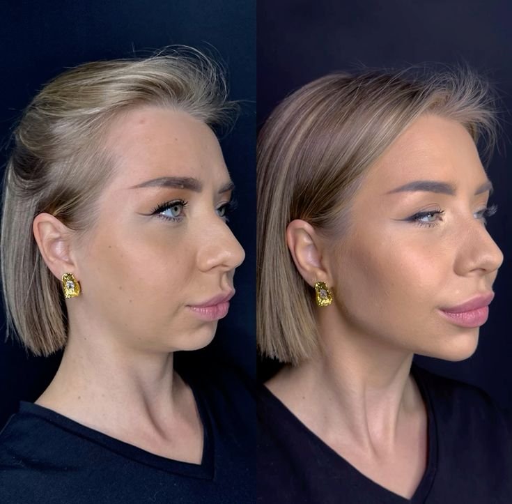 Cheek Fillers Near Me for Safe Non Surgical Cheek Augmentation