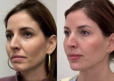 Cheek Fillers Before and After