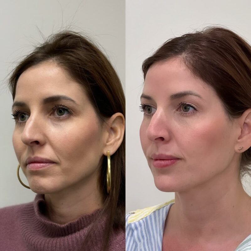 Cheek Fillers Before and After