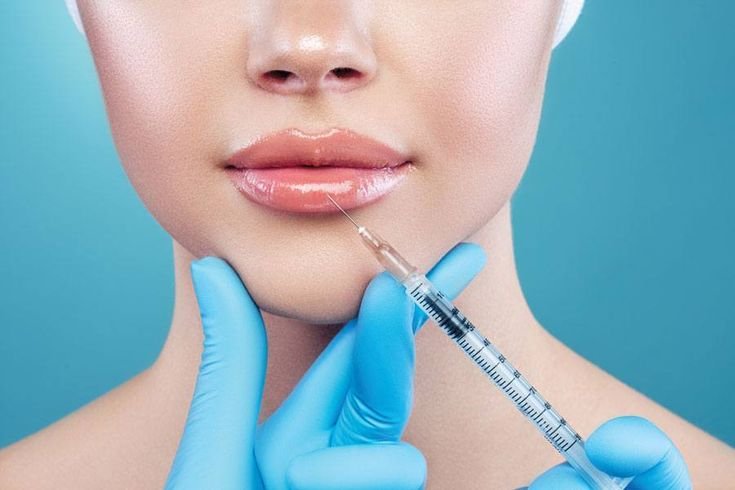 lip filler before and after