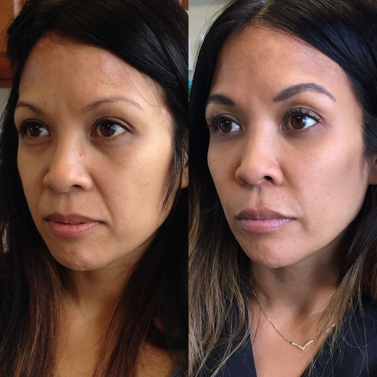 Nasolabial Fold Filler Cost Guide for Smile Line Treatment & Rejuvenation