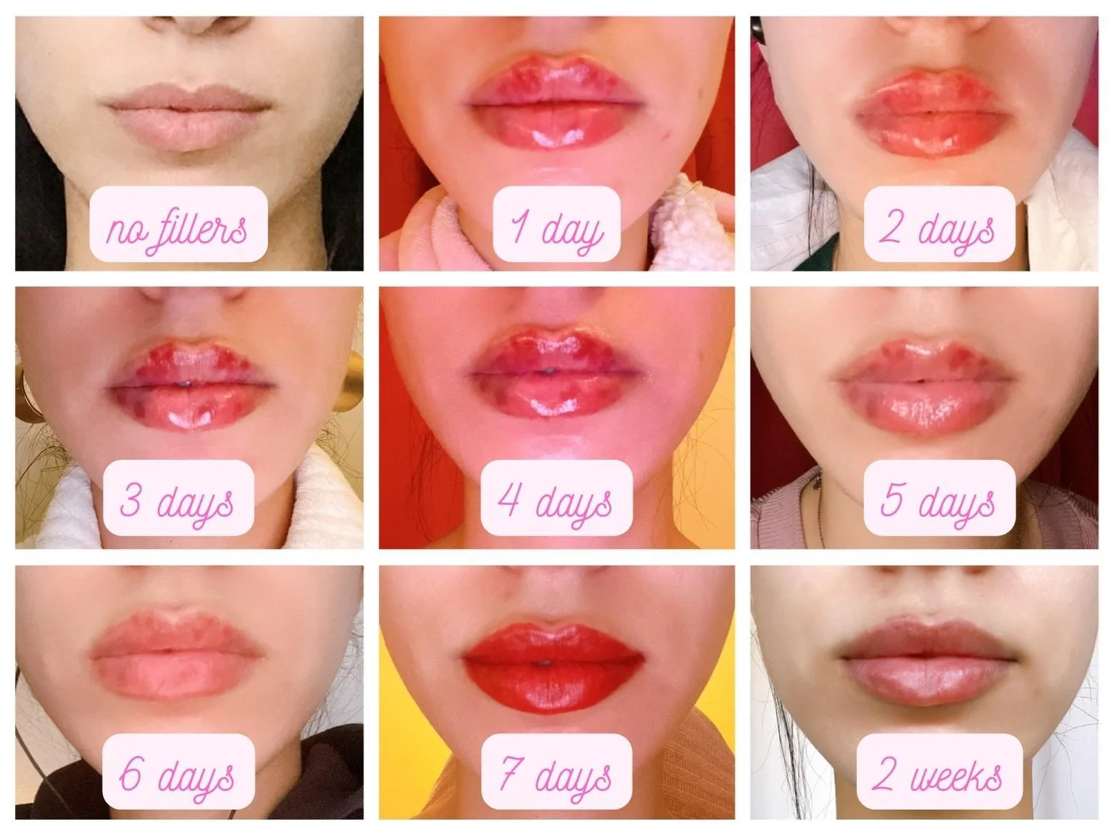 Lip Filler Swelling Stages