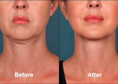 Buy Hyperdilute Radiesse Online