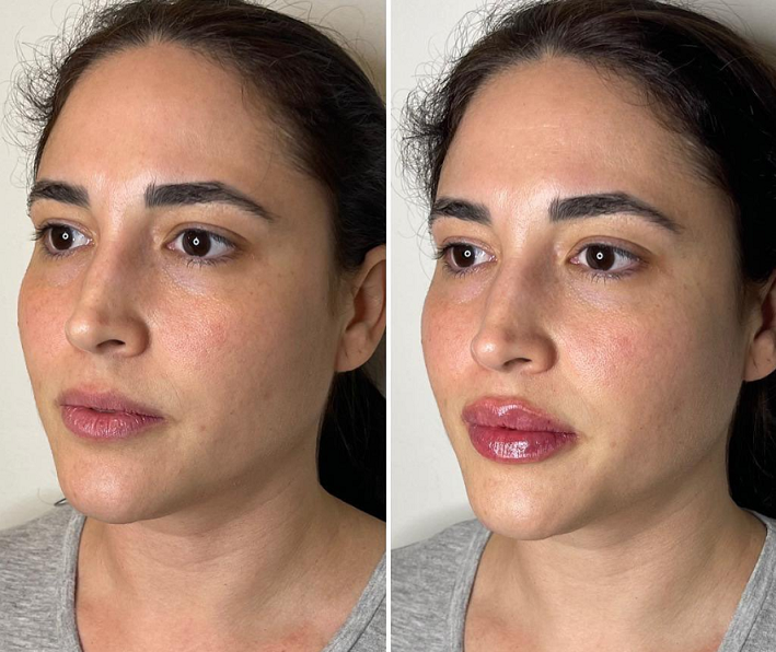 Restylane Kysse Lip Filler