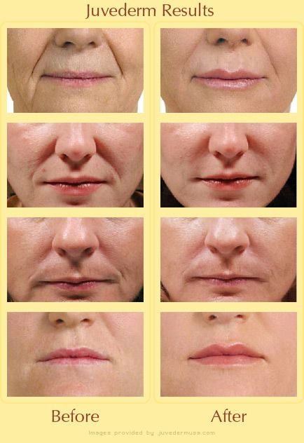 Juvederm Before and After: Real Results for Lips