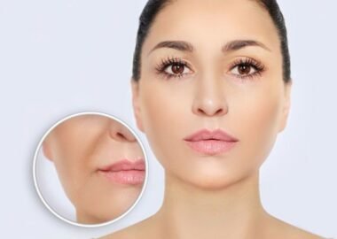 : nasolabial fold filler