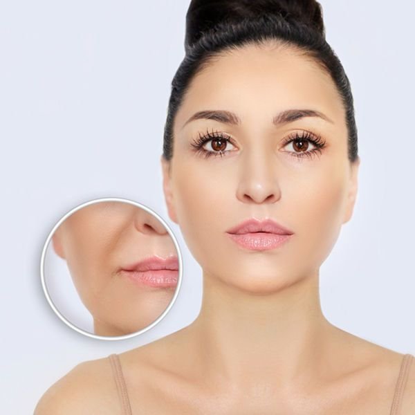 : nasolabial fold filler