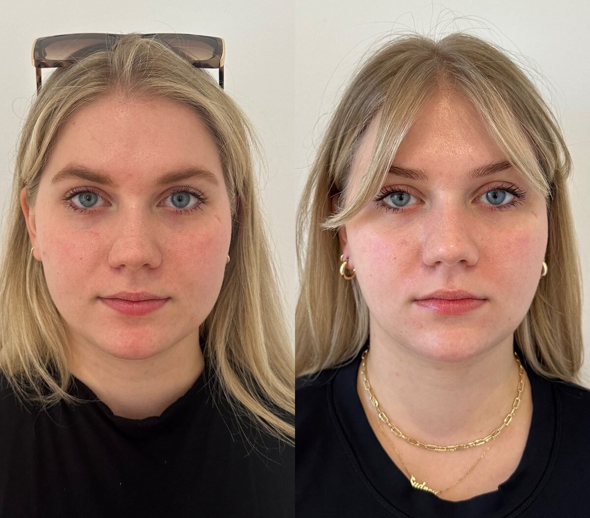 Masseter Botox Before and After