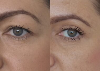 botox augenbrauen vorher nachher