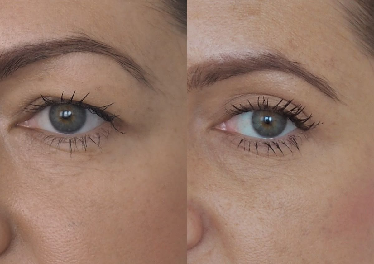 botox augenbrauen vorher nachher