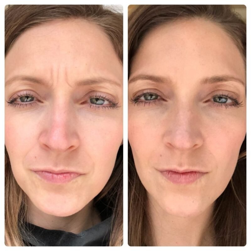 Botox Before and After