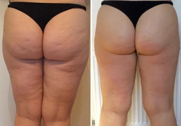 Sculptra Before and After Results Including Sculptra BBL Cost and Treatment Recovery