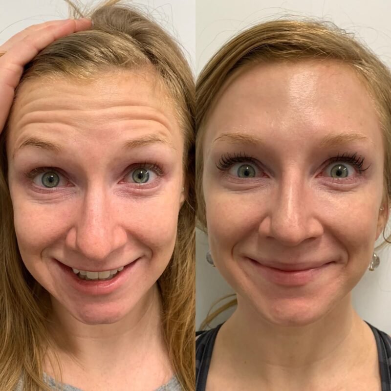 botox vorher nachher