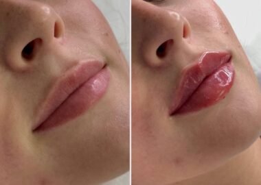 realistic 1ml lip filler before and after thin lips