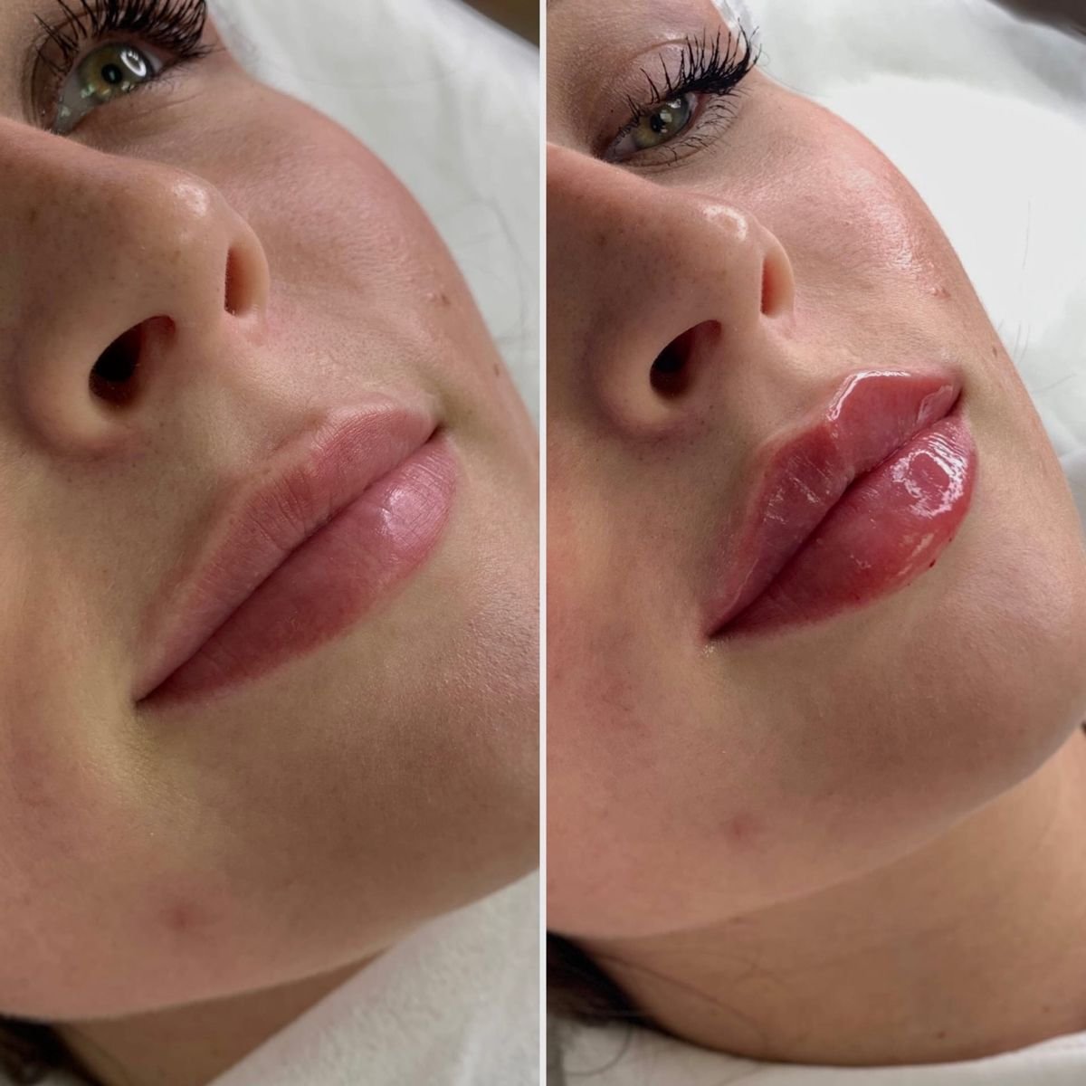 realistic 1ml lip filler before and after thin lips