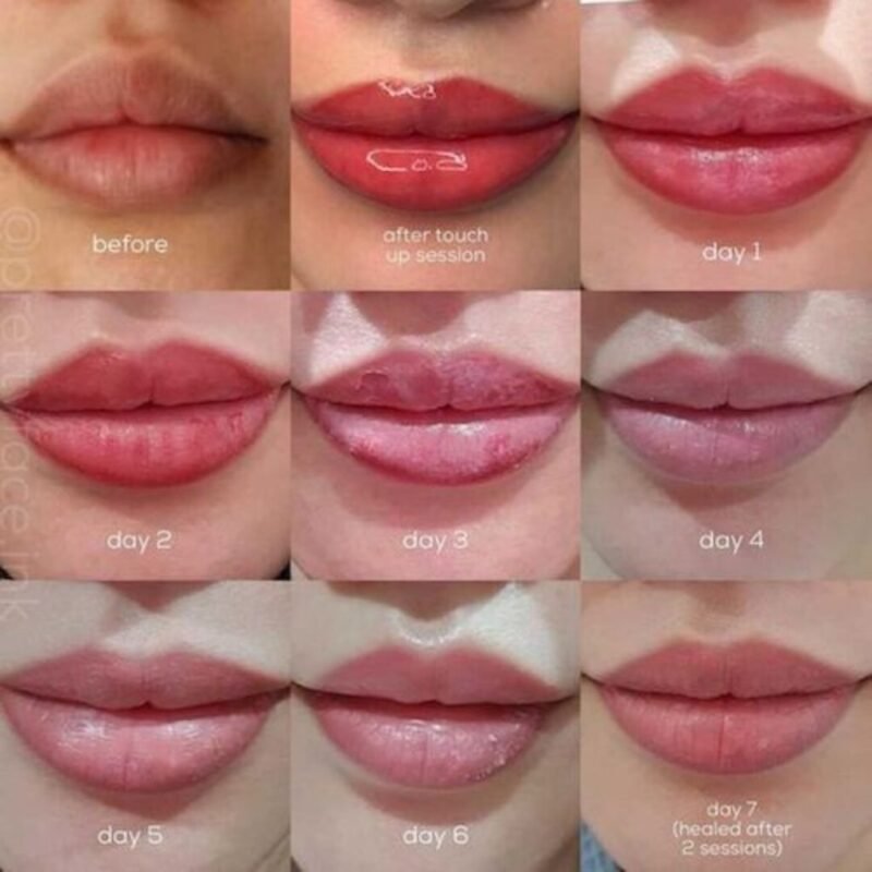 0.5 ML Lip Filler Swelling Stages